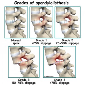 spondylolisthesis_back_pain